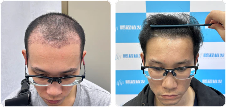 張先接受中胚層生髪前與生髪後真實案例對比圖