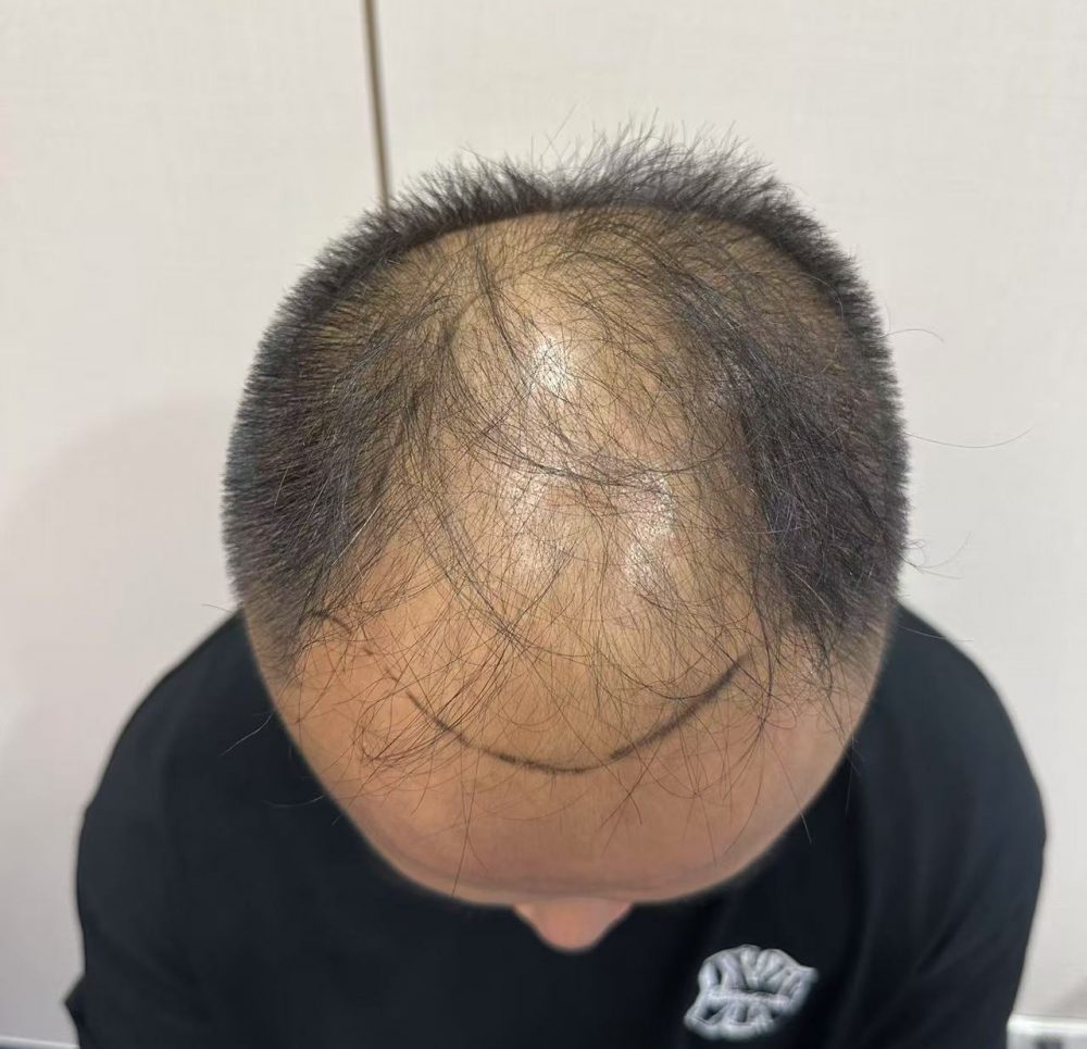 地中海脫髮