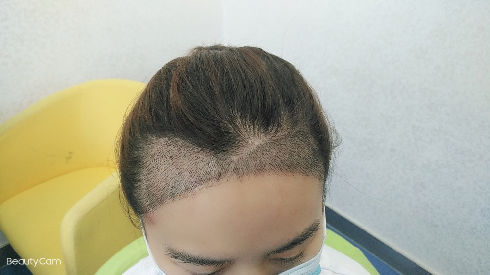 術後5天