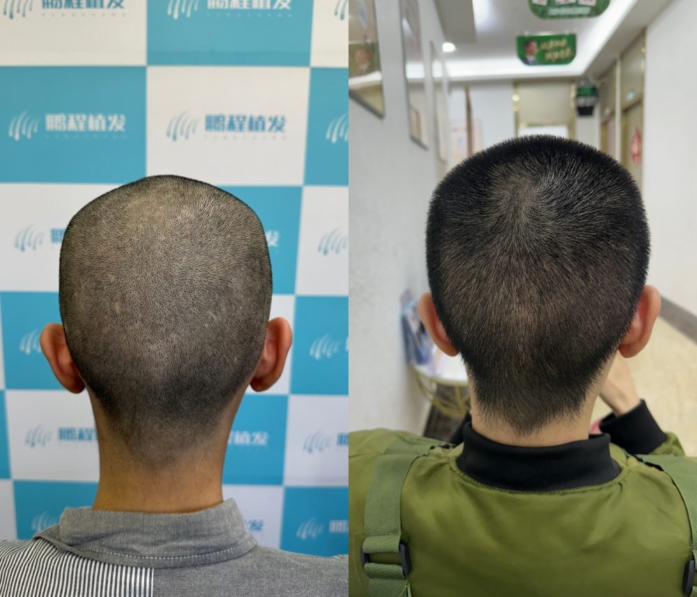 植髮後枕毛囊