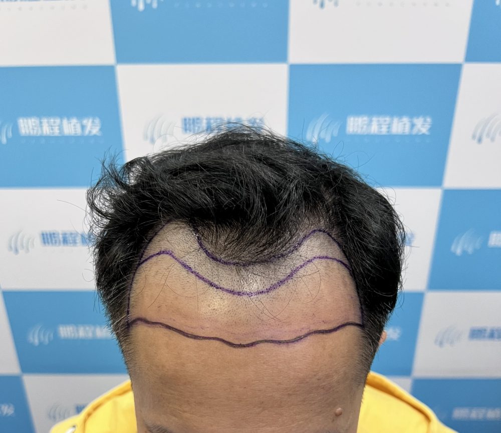 雄激素性脫髮