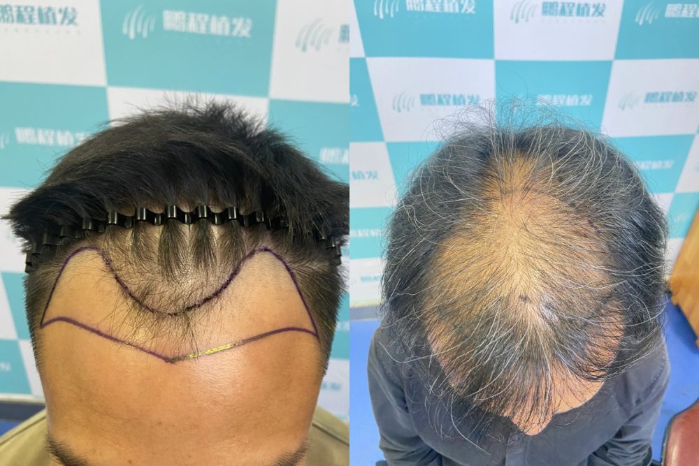 🧑‍🦱 男士M禿+頭頂稀疏 脫髮到幾級才可以植髮？｜植髮黃金期指南